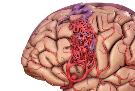 Как называется кровоизлияние в мозг