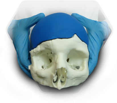 Нейрохирургические операции. 3D-моделирование импланта черепа пациента