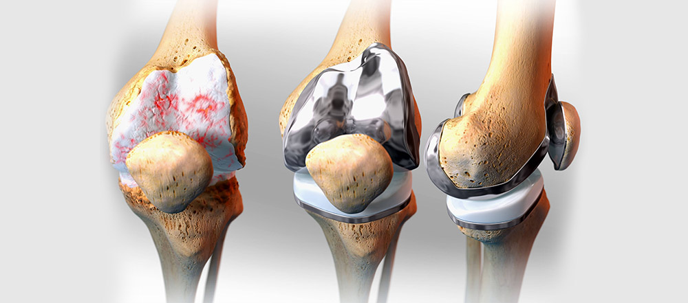 Эндопротезирование коленного сустава белоруссия
