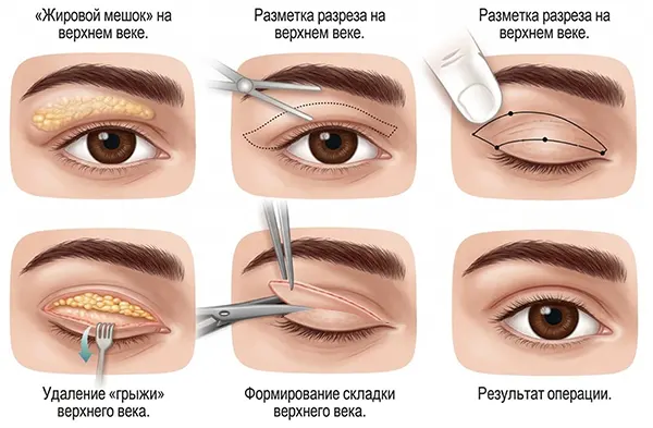 Верхняя блефаропластика