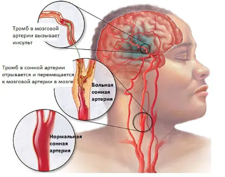 цереброваскулярная энцефалопатия