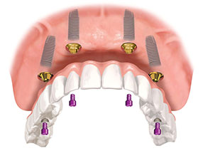 Дентальная имплантация и синус-лифтинг зубов